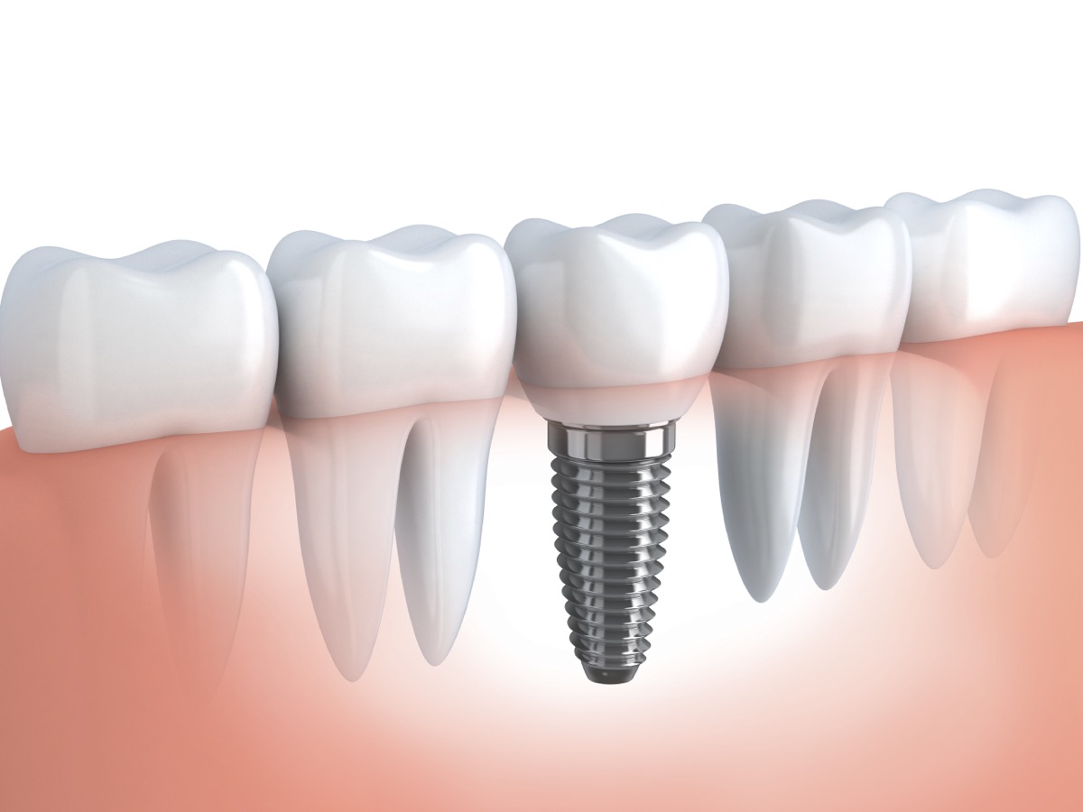 Pose d'implants dentaires à Deroua
