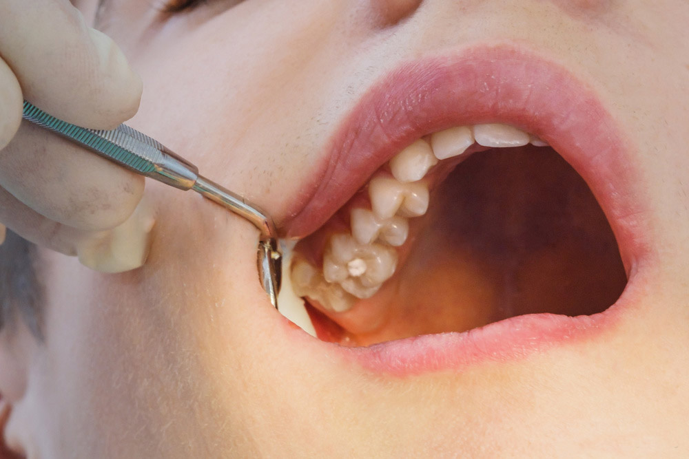 Soins dentaires — détartrage et caries à Deroua